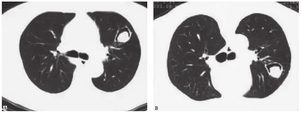 图10 肺曲霉菌球胸部CT表现.jpg
